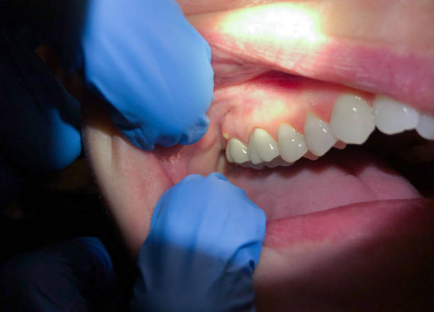 Best Emergency Broken Tooth Repair in Pine Mountain Lake, CA